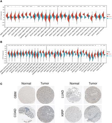 Oncogenic role and drug sensitivity of ETV4 in human tumors: a pan-cancer analysis